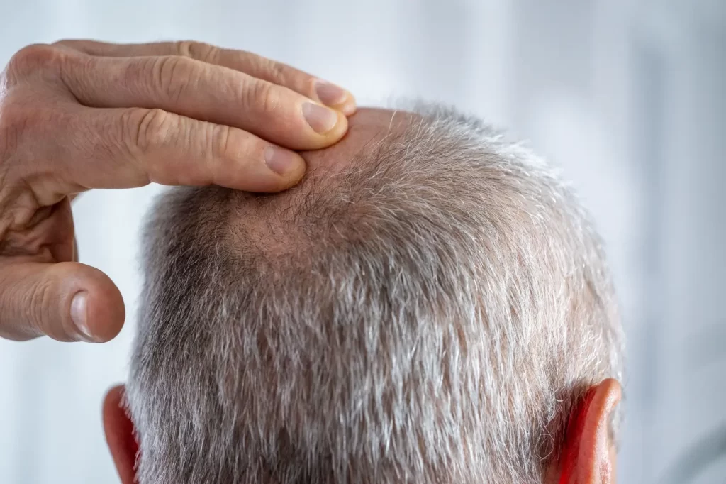 Person touches the crown of the head where thinning hair is visible.