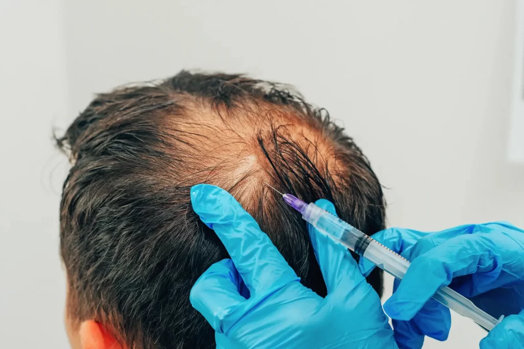 Clinician wearing blue gloves performs a scalp injection on a person with thinning hair.